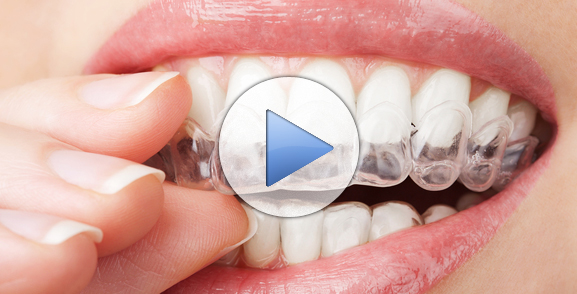 Invisalign Clear Braces in Toledo Ohio | Maumee Ohio