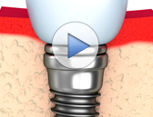 Bone Grafts