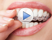 Invisalign