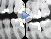Periodontal Disease