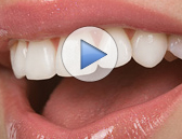 Veneers