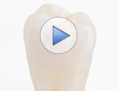 Wisdom Teeth