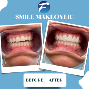 Before and after photo of dental patient with dental enhancements 