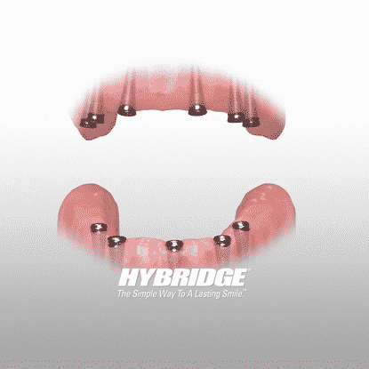 Gif of how Hybridge dental implants work