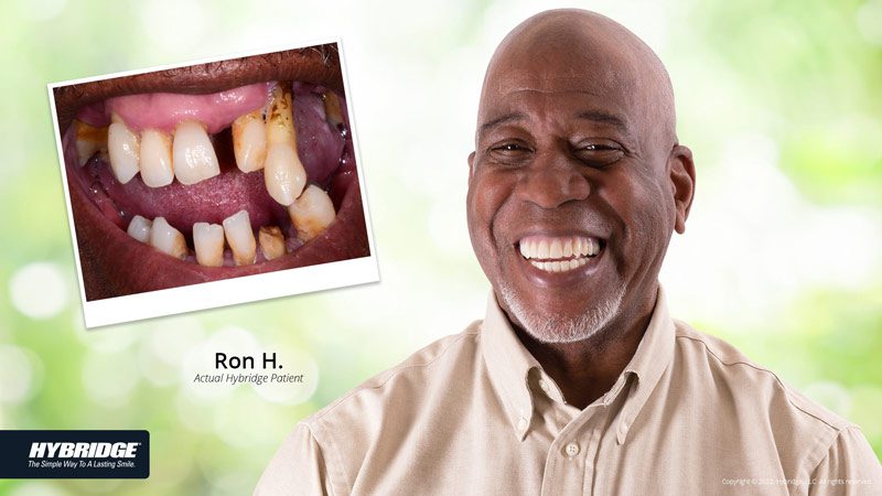 Hybridge dental implant patient - Jon Frankel Dentistry in Maumee Ohio